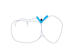 Figure 20: The improper use of attempting to push the dam between the teeth with floss Figure 20: The improper use of attempting to push the dam between the teeth with floss