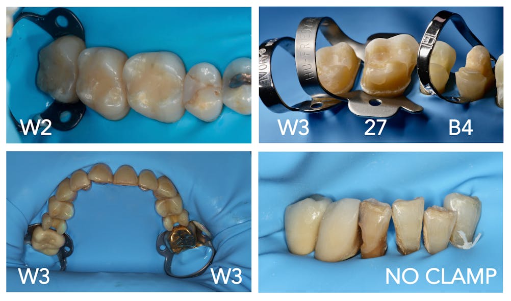 Figure 21: Typical rubber dam isolations depicting clamps W2, W3, 27, B4, and the use of a floss ligature
