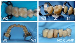 Figure 21: Typical rubber dam isolations depicting clamps W2, W3, 27, B4, and the use of a floss ligature Figure 21: Typical rubber dam isolations depicting clamps W2, W3, 27, B4, and the use of a floss ligature