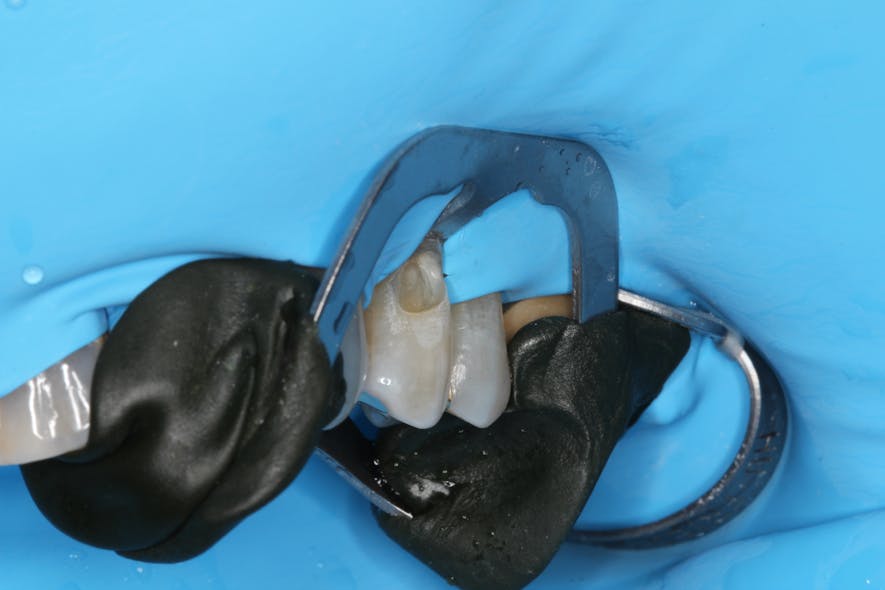 Figure 22: 212 retractor in position, stabilized with green impression compound