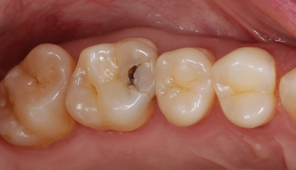 Figure 23: Failing composite with deep caries threatening the pulp