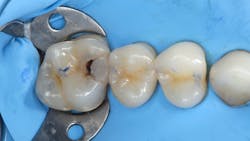 Figure 24: Typical rubber dam isolation for initiating treatment Figure 24: Typical rubber dam isolation for initiating treatment