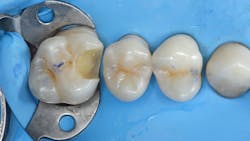 Figure 25: After caries removal, pulp capping completed with MTA followed by RMGI liner Figure 25: After caries removal, pulp capping completed with MTA followed by RMGI liner