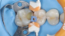 Figure 26: Matrix assembly in place for class II composite Figure 26: Matrix assembly in place for class II composite