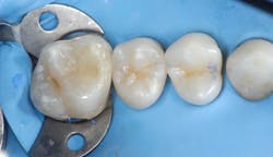 Figure 27: Initial restoration before final finishing and polishing Figure 27: Initial restoration before final finishing and polishing