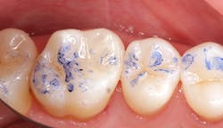 Figure 28: Final restoration after occlusal adjustment Figure 28: Final restoration after occlusal adjustment