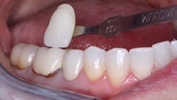 Figure 3: Open margin on a crown with caries that almost exposed the pulp when removed was seated with resin cement.