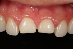 Figure 3: Finished ceramic veneer preparations Figure 3: Finished ceramic veneer preparations