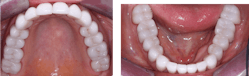 Figure 4: The current generation of zirconia crowns can be both beautiful and functional.