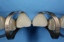 Figure 4: Isolation with rubber dam. Note how the B4 clamps retract tissue. Figure 4: Isolation with rubber dam. Note how the B4 clamps retract tissue.