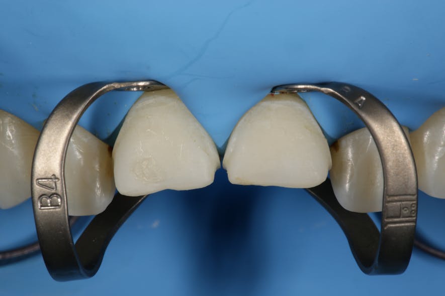 Figure 4: Isolation with rubber dam. Note how the B4 clamps retract tissue.
