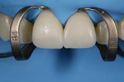 Figure 5: Try-in of veneers. The retracted field allows for easy visual inspection of marginal adaptation. Figure 5: Try-in of veneers. The retracted field allows for easy visual inspection of marginal adaptation.