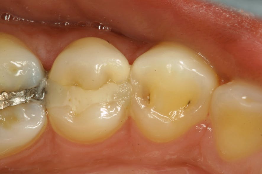 Figure 6: The presence of plaque and inflamed gingival tissues will contribute to bleeding issues if no dam is employed.