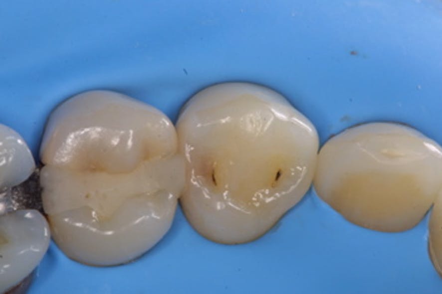 Figure 7: After rubber dam application, bleeding and gingival exudates are prevented from interfering with the procedure.
