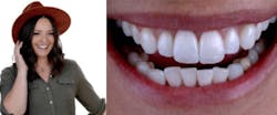 Figure 1: Final portrait/intraoral photographs of the patient and definitive all-ceramic crowns on the maxillary central incisors. Figure 1: Final portrait/intraoral photographs of the patient and definitive all-ceramic crowns on the maxillary central incisors.