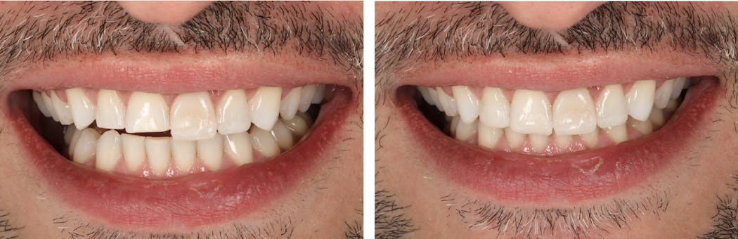 Figure 2: A mock-up was completed using the selected composite resin shades. The patient and the dentist could visualize the final contours of the restorations.