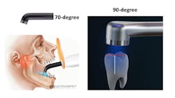 Figure 2: It’s obvious in this Ultradent image that no one can open wide enough to make the light beam perpendicular to the resin surface in some mouth locations with a 70-degree light guide. 90-degree light guides are advisable. Figure 2: It’s obvious in this Ultradent image that no one can open wide enough to make the light beam perpendicular to the resin surface in some mouth locations with a 70-degree light guide. 90-degree light guides are advisable.