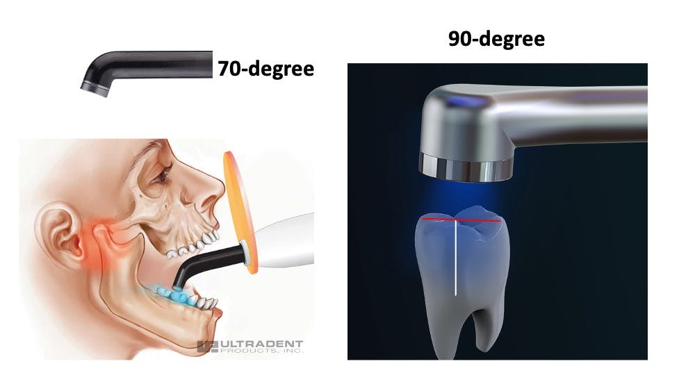 Figure 2: It&rsquo;s obvious in this Ultradent image that no one can open wide enough to make the light beam perpendicular to the resin surface in some mouth locations with a 70-degree light guide. 90-degree light guides are advisable.