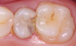 Figure 1: Teeth such as this one are often treated with endodontics when more conservative procedures could have been done. This patient is a 15-year-old male whose family did not have the financial ability for extensive treatment. Conservative treatment with composite at least for a few years could possibly save the vitality of this tooth.