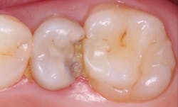 Figure 1: Teeth such as this one are often treated with endodontics when more conservative procedures could have been done. This patient is a 15-year-old male whose family did not have the financial ability for extensive treatment. Conservative treatment with composite at least for a few years could possibly save the vitality of this tooth. Figure 1: Teeth such as this one are often treated with endodontics when more conservative procedures could have been done. This patient is a 15-year-old male whose family did not have the financial ability for extensive treatment. Conservative treatment with composite at least for a few years could possibly save the vitality of this tooth.