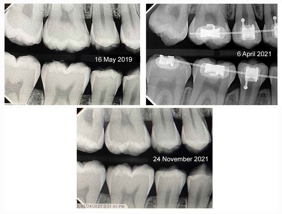 SDF application on posterior contacting axial surfaces in orthodontic ...