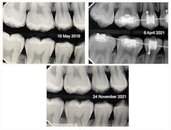 Figure 2: Bitewing radiographs are taken (May 16, 2019, April 6, 2021, November 24, 2021). Figure 2: Bitewing radiographs are taken (May 16, 2019, April 6, 2021, November 24, 2021).