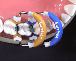 Figure 2: You can create a proper contour between teeth with the rings.