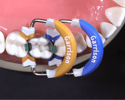 Figure 2: You can create a proper contour between teeth with the rings. Figure 2: You can create a proper contour between teeth with the rings.