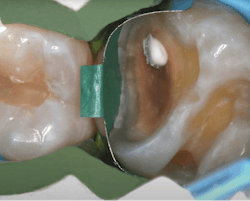 Figure 3: The width of the wide green ring allows for proper contour in situations with greater buccolingual preparation widths. Figure 3: The width of the wide green ring allows for proper contour in situations with greater buccolingual preparation widths.