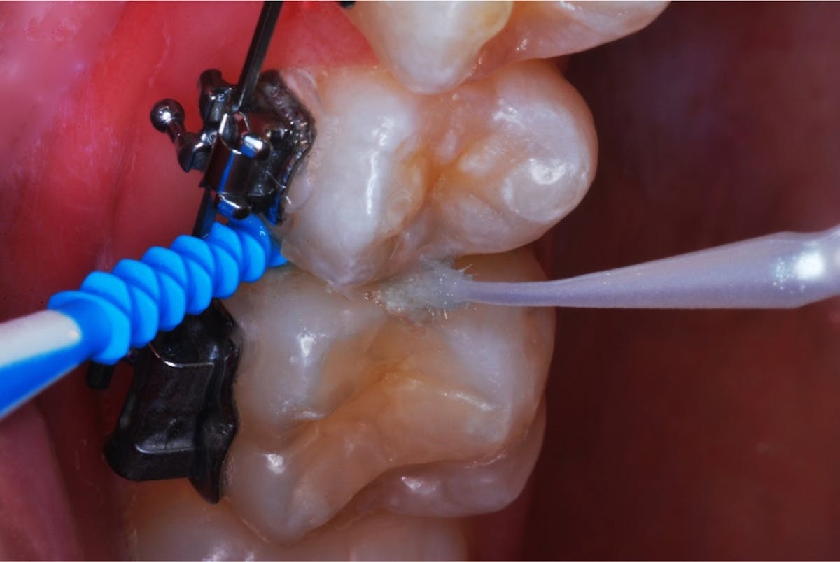 SDF application on posterior contacting axial surfaces in orthodontic ...