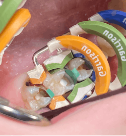 Figure 4: All three sizes of rings are stacked and create proper contours prior to composite insertion. Figure 4: All three sizes of rings are stacked and create proper contours prior to composite insertion.