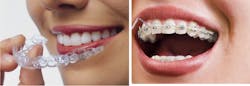Figure 4: Movement of teeth by aligners for slightly or moderately malposed teeth is well proven to be successful if accomplished properly. However, unless significant additions are made to simplify aligner treatment, conventional orthodontic procedures are preferred by most orthodontists and GPs doing orthodontic treatment. Figure 4: Movement of teeth by aligners for slightly or moderately malposed teeth is well proven to be successful if accomplished properly. However, unless significant additions are made to simplify aligner treatment, conventional orthodontic procedures are preferred by most orthodontists and GPs doing orthodontic treatment.