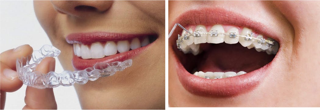 Figure 4: Movement of teeth by aligners for slightly or moderately malposed teeth is well proven to be successful if accomplished properly. However, unless significant additions are made to simplify aligner treatment, conventional orthodontic procedures are preferred by most orthodontists and GPs doing orthodontic treatment.