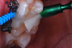 Figure 5: The treatment site is soaked with 5% fluoride varnish. Figure 5: The treatment site is soaked with 5% fluoride varnish.