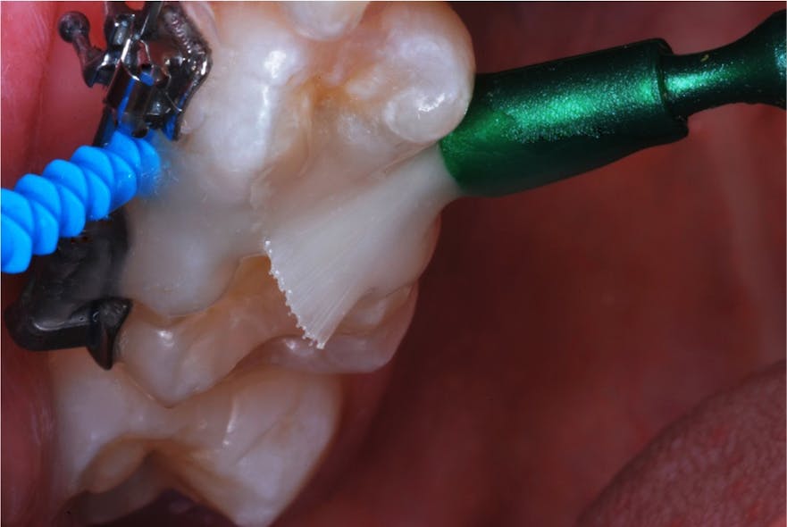 Figure 5: The treatment site is soaked with 5% fluoride varnish.