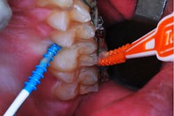 Figure 8: A pick is inserted lingually, and double picks are inserted buccally. Figure 8: A pick is inserted lingually, and double picks are inserted buccally.