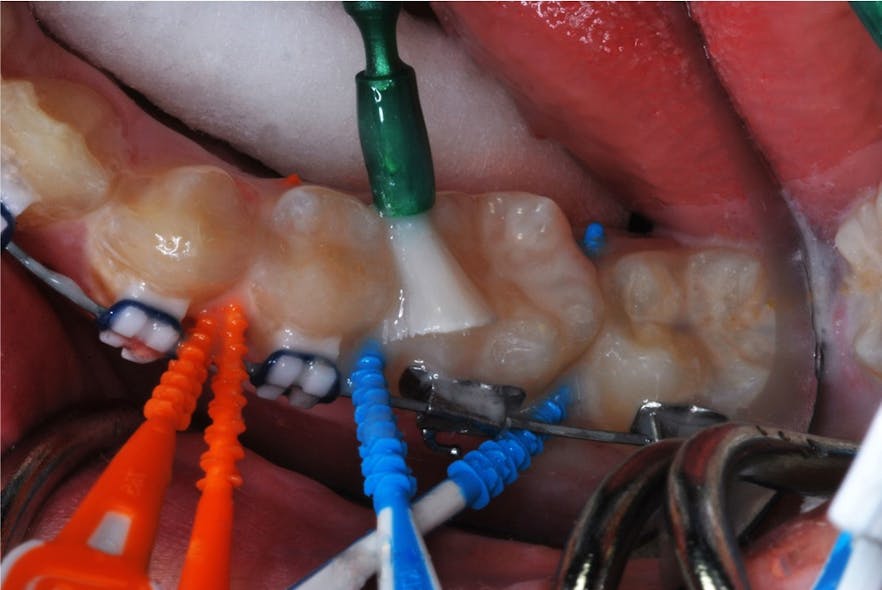 Figure 9: Fluoride varnish is applied after using multiple picks over and under the arch wires.