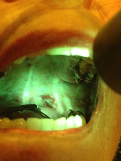 Figure 1c: OralID showing carcinoma in situ Figure 1c: OralID showing carcinoma in situ