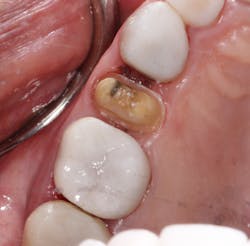 Figure 11: Tooth no. 13 ready for final Figure 11: Tooth no. 13 ready for final