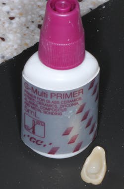 Figure 12: Treatment of primer to restoration