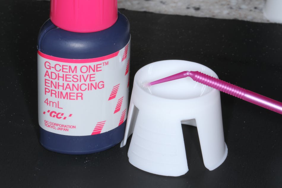 Dental cementation Evolution to revolution in everyday dentistry