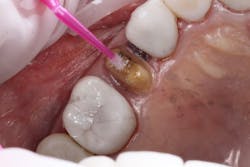 Figure 14: G-CEM One adhesive enhancing primer to tooth no. 13 Figure 14: G-CEM One adhesive enhancing primer to tooth no. 13