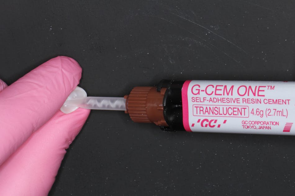 Dental cementation Evolution to revolution in everyday dentistry