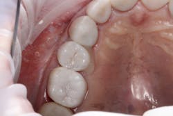 Figure 16: Seat restoration Figure 16: Seat restoration