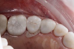 Figure 17: Tack cure and completed restoration Figure 17: Tack cure and completed restoration