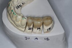 Figure 2: Zirconia restorations Figure 2: Zirconia restorations