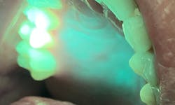 Figure 1a: OralID showing mild epithelial dysplasia Figure 1a: OralID showing mild epithelial dysplasia