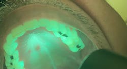 Figure 1b: OralID showing moderate epithelial dysplasia Figure 1b: OralID showing moderate epithelial dysplasia