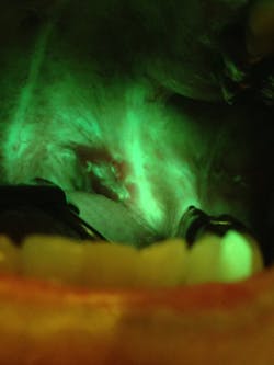 Figure 1d: OralID showing carcinoma in situ Figure 1d: OralID showing carcinoma in situ