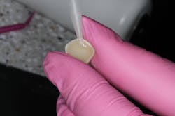 Figure 5: Load self-adhesive resin cement (G-CEM One) Figure 5: Load self-adhesive resin cement (G-CEM One)